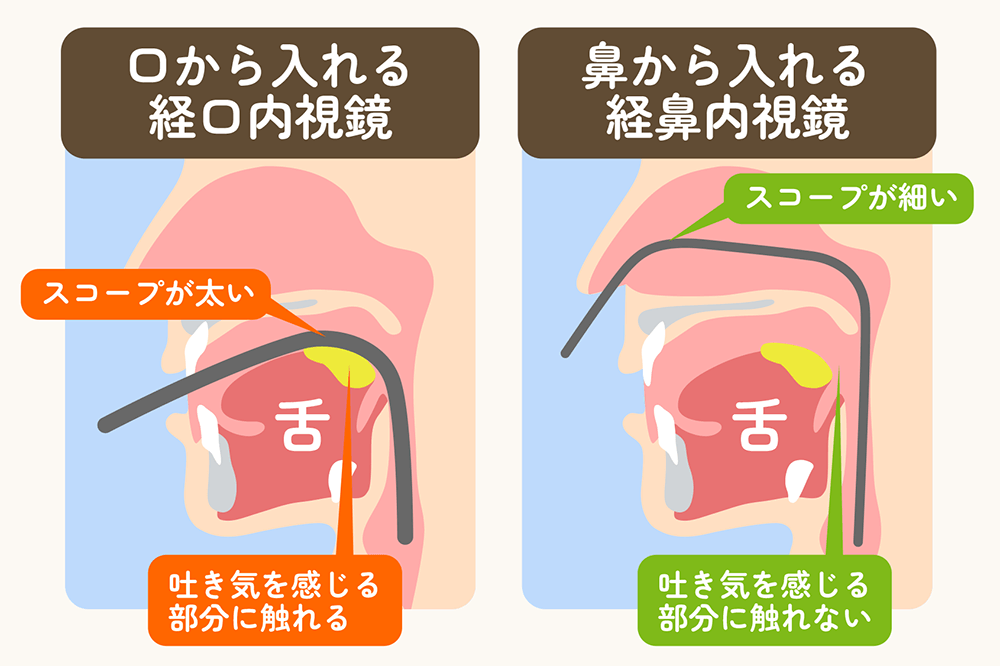 大分市のにのみや内科・消化器科「経口内視鏡と経鼻内視鏡の違い」